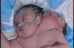 تولد نوزاد دو سر در بغداد