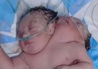تولد نوزاد دو سر در بغداد تولد نوزاد دو سر در بغداد